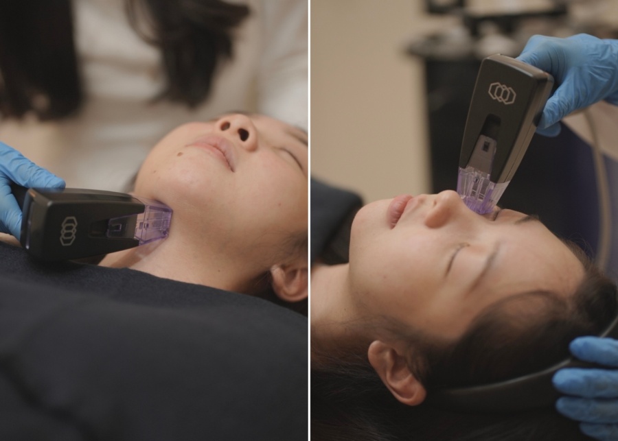 Best microneedling services in Singapore - Mirae Medical Aesthetics Morpheus8