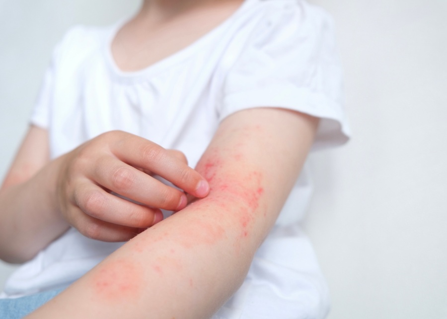 Dealing with eczema flare-ups? Here are 5 unexpected triggers revealed by experts