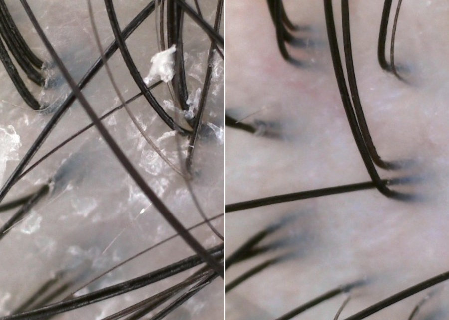 TK TrichoKare Dandruff Defense treatment review - A side-by-side comparison of the pre- and post-treatment scans