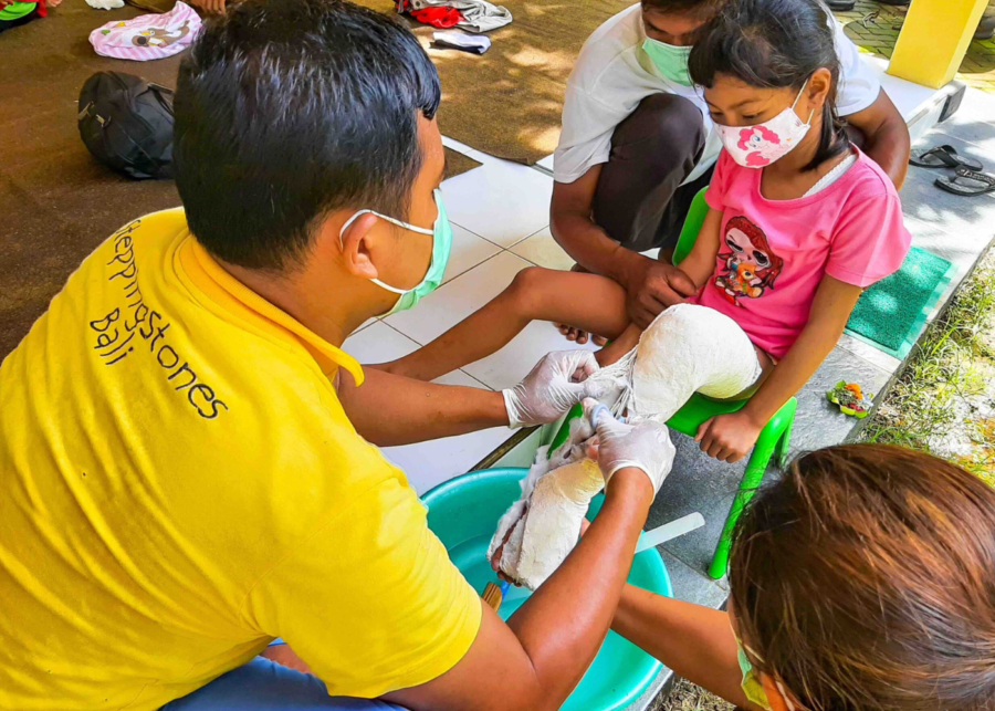 A Stepping Stones Bali clinician applying a leg cast for a young girl receiving treatment for clubfoot.